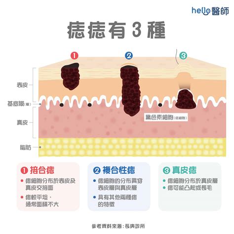 身體長誌|痣是什麼？一次了解痣原因、就醫時機以及如何改善